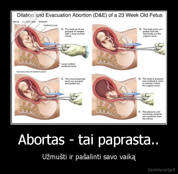 Abortas - tai paprasta..